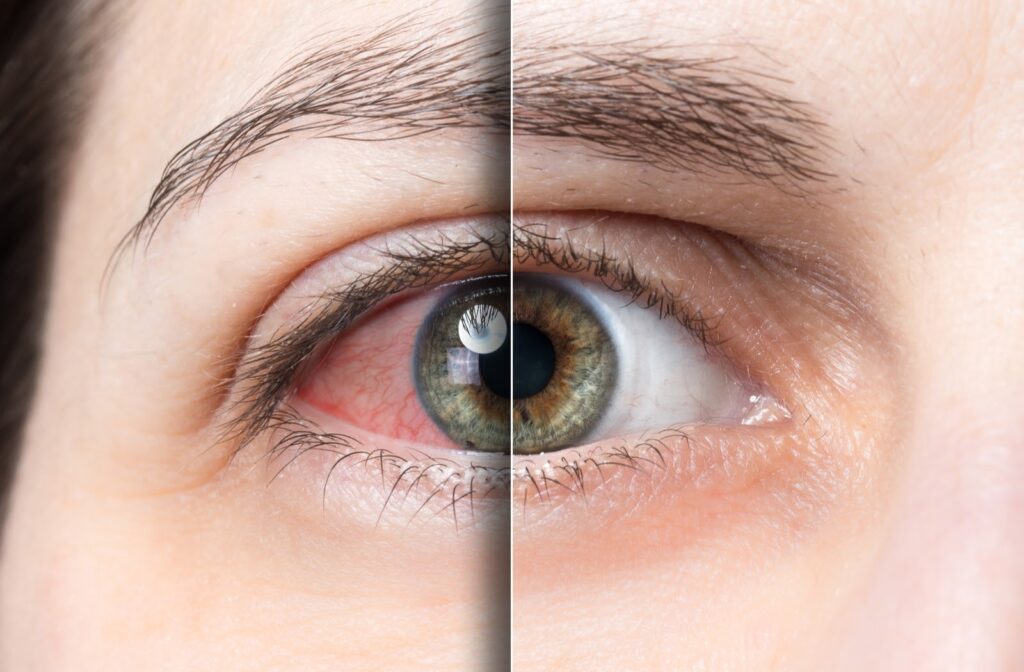 Photo of green eye before and after dry eye treatment with redness visible on left side